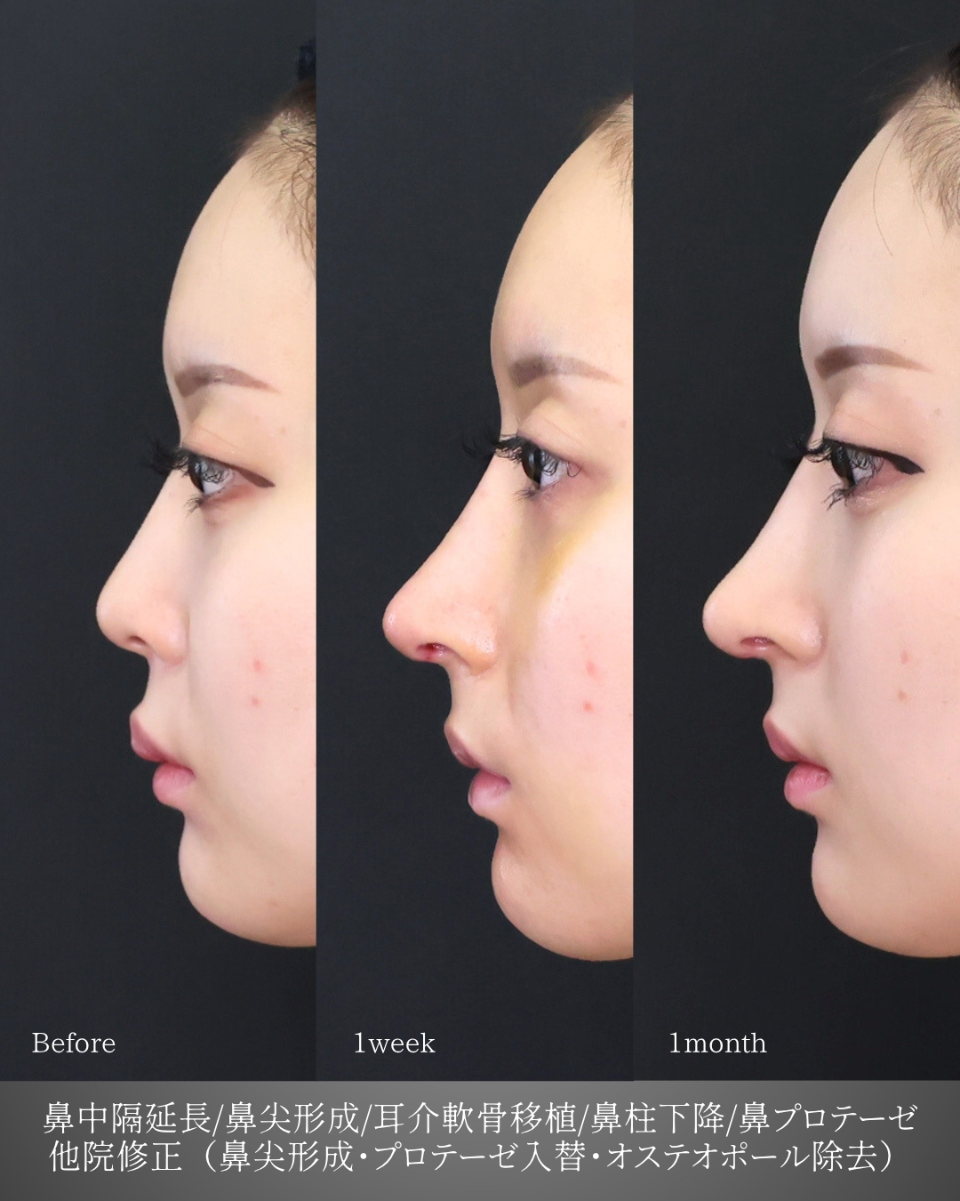鼻中隔延長術/鼻尖形成・鼻尖縮小/鼻先軟骨移植の症例写真 施術前後 