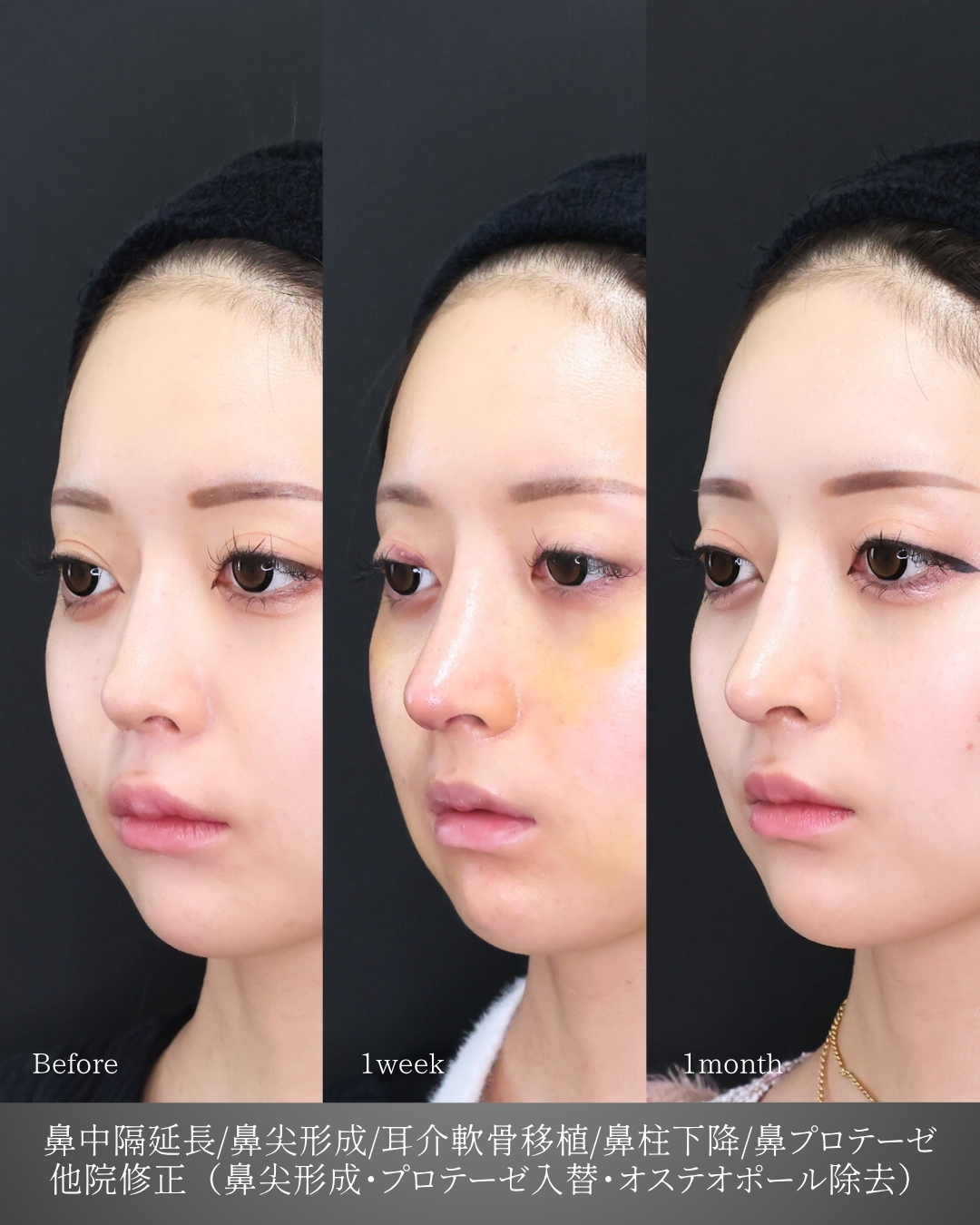 鼻中隔延長術/鼻尖形成・鼻尖縮小/鼻先軟骨移植の症例写真 施術前後 