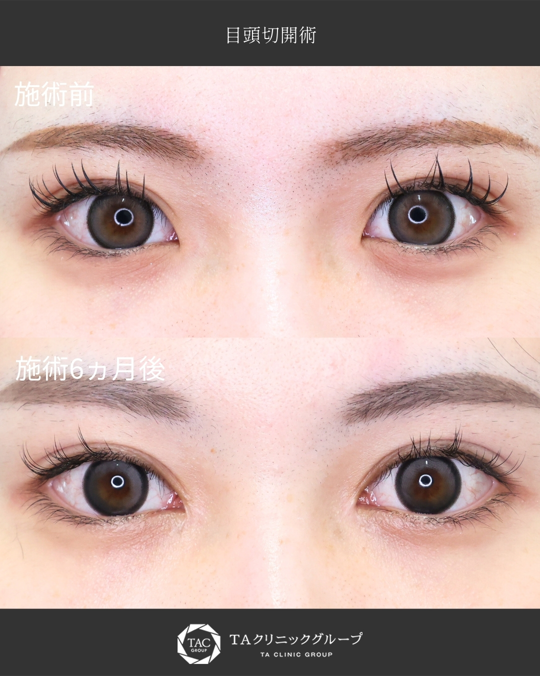 【目頭切開】蒙古襞改善で綺麗なアーモンドeyeに