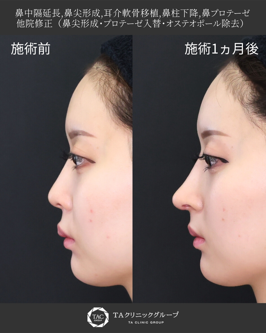 【鼻フル整形】｜丸く上向きの鼻を整えて「ちゅん鼻」に！｜