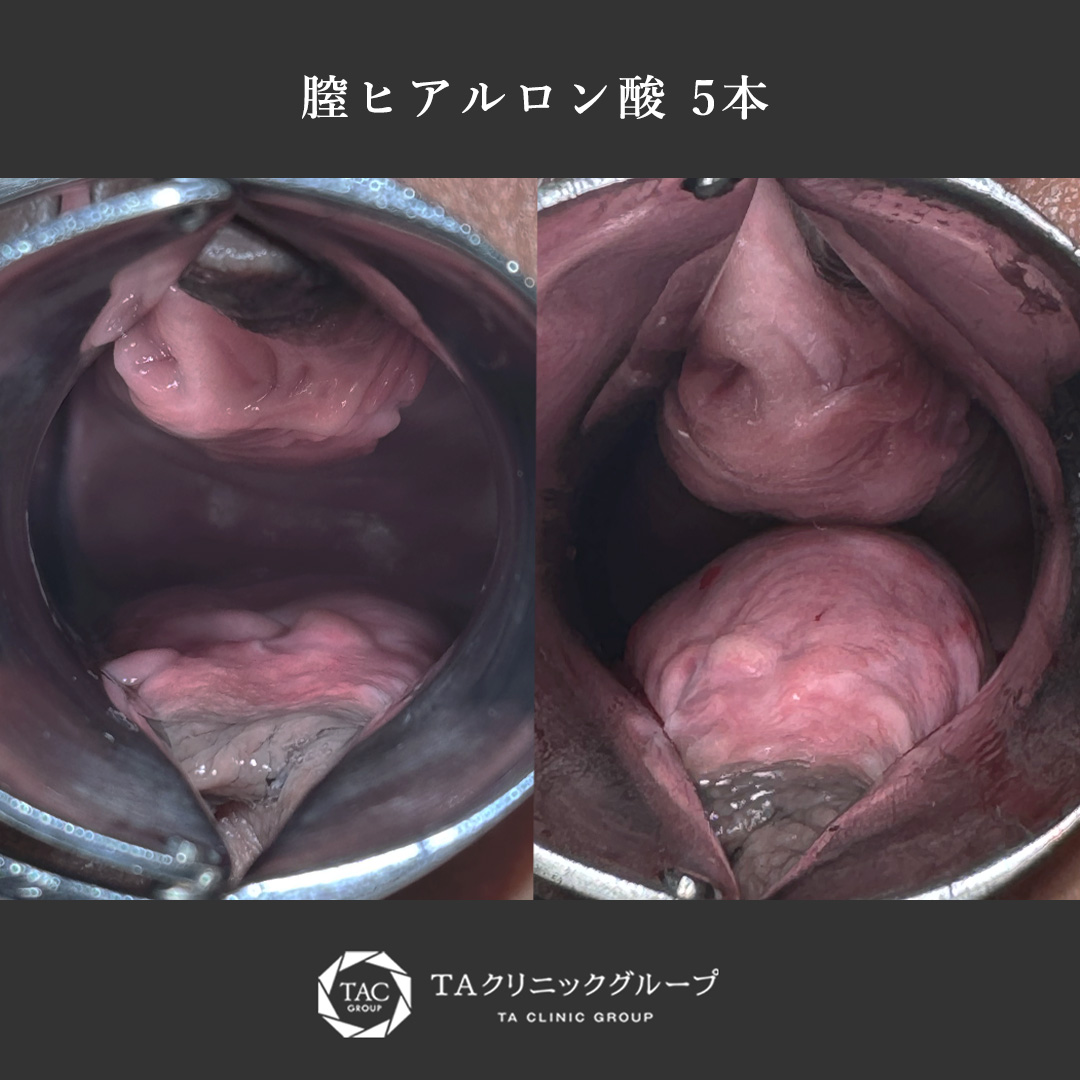 【感度・尿漏れ改善!】膣ヒアルで快適な生活へ
