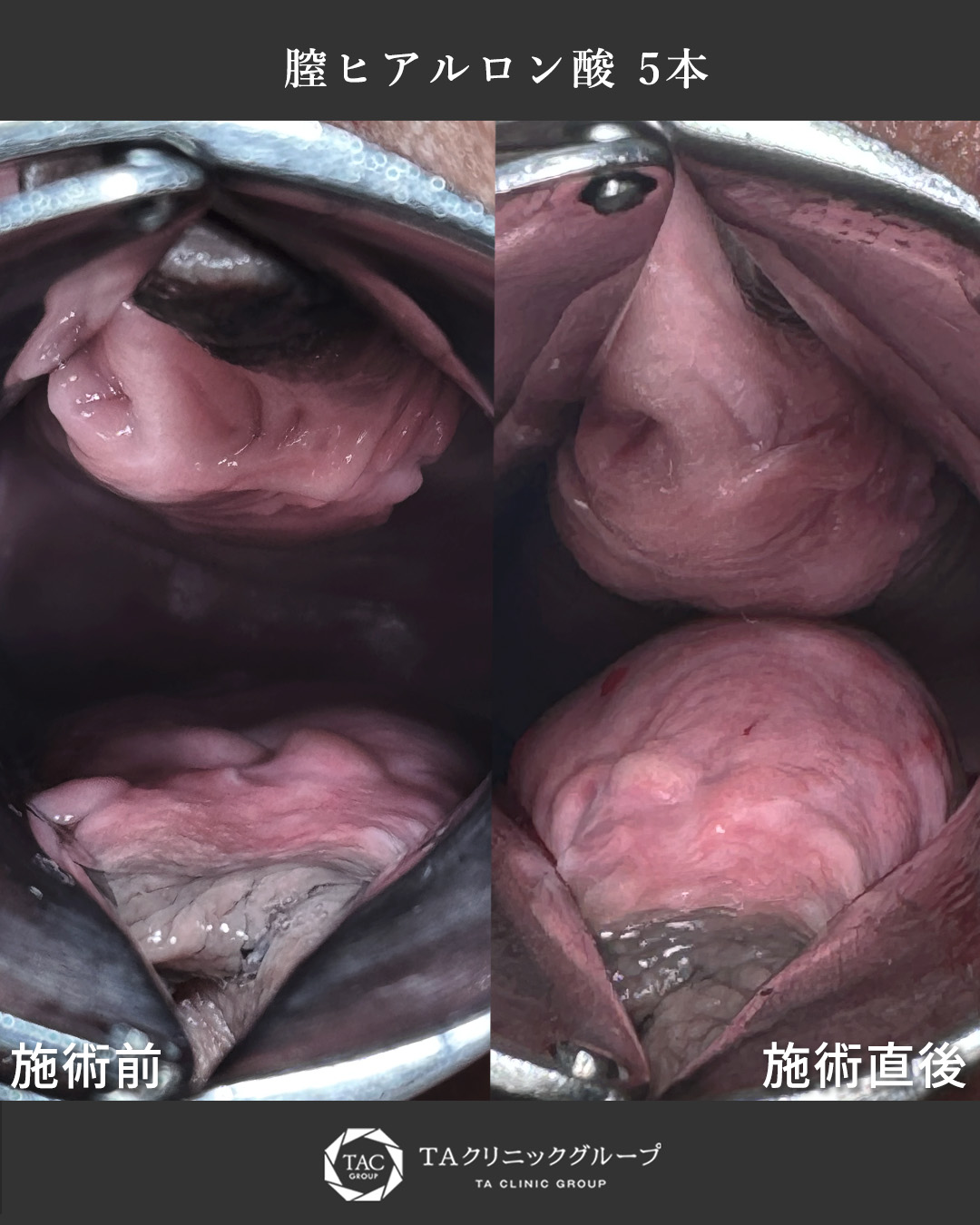 【感度・尿漏れ改善！】膣ヒアルで快適な生活へ