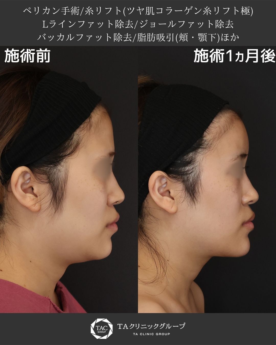 ペリカン手術＋糸リフトで二重アゴ・たるみを改善