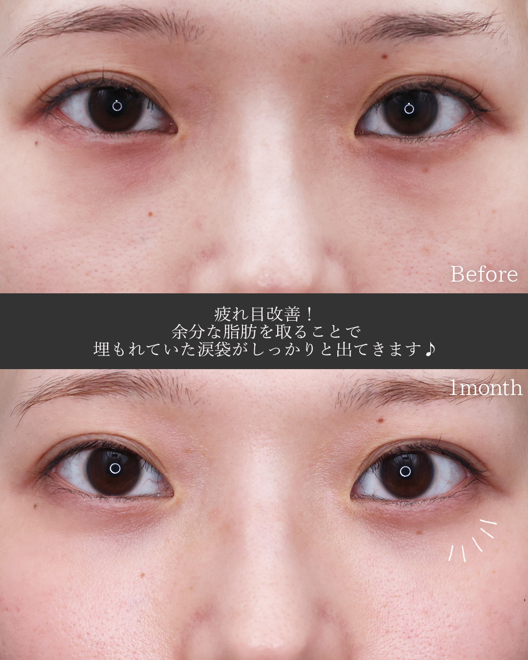 下眼瞼脱脂術（目の下のたるみ取り・目の下の脂肪ふくらみ取り）/顔の脂肪注入(コンデンスリッチフェイス)の症例写真 施術前後 