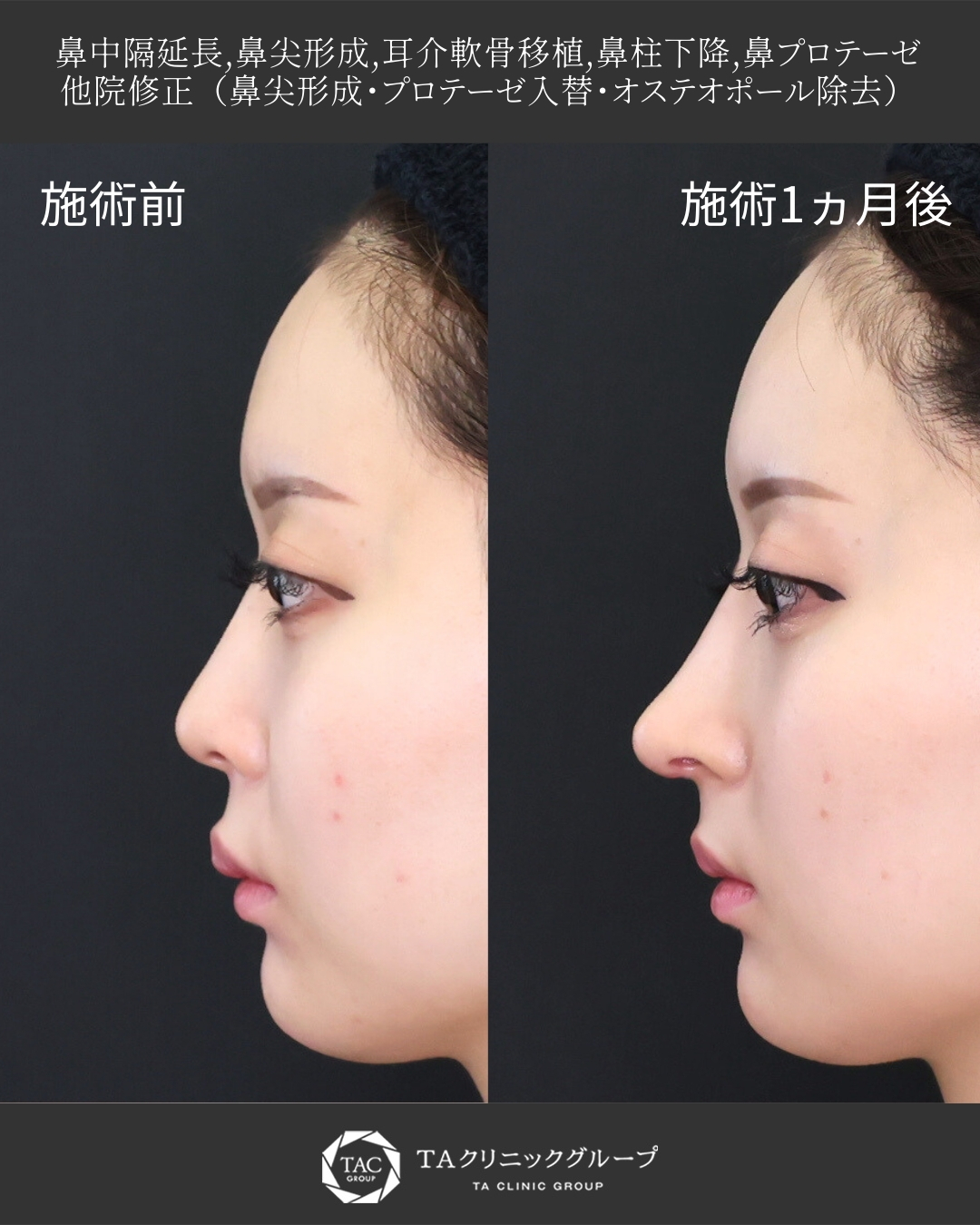 【鼻フル整形】|丸く上向きの鼻を整えて「ちゅん鼻」に!|