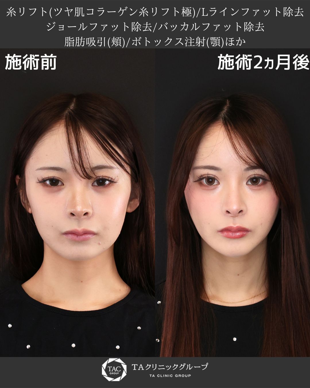 理想の卵型フェイスへ。下顔面をすっきりアップデート