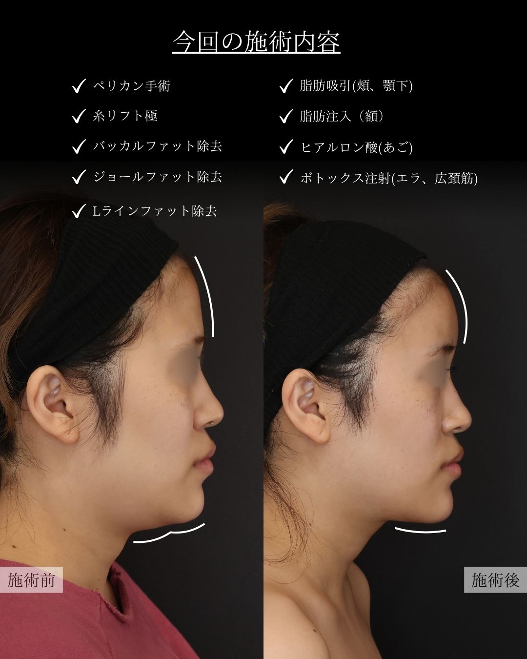 バッカルファット除去/エラボトックス注射/ジョールファット除去の症例写真 施術前後 