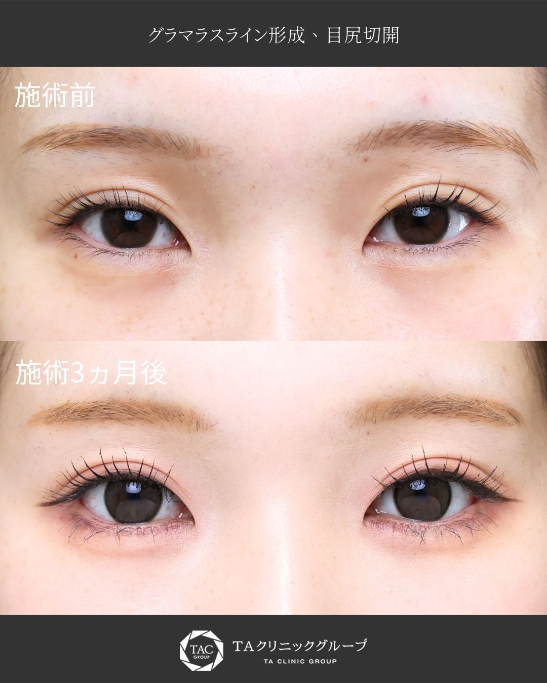 『タレ目形成』～ナチュラルタレ目に～