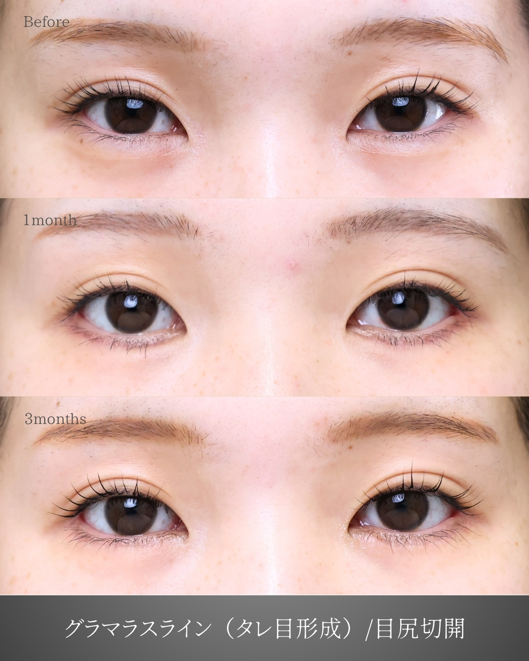グラマラスライン（タレ目形成）/目尻切開術の症例写真 施術前後 