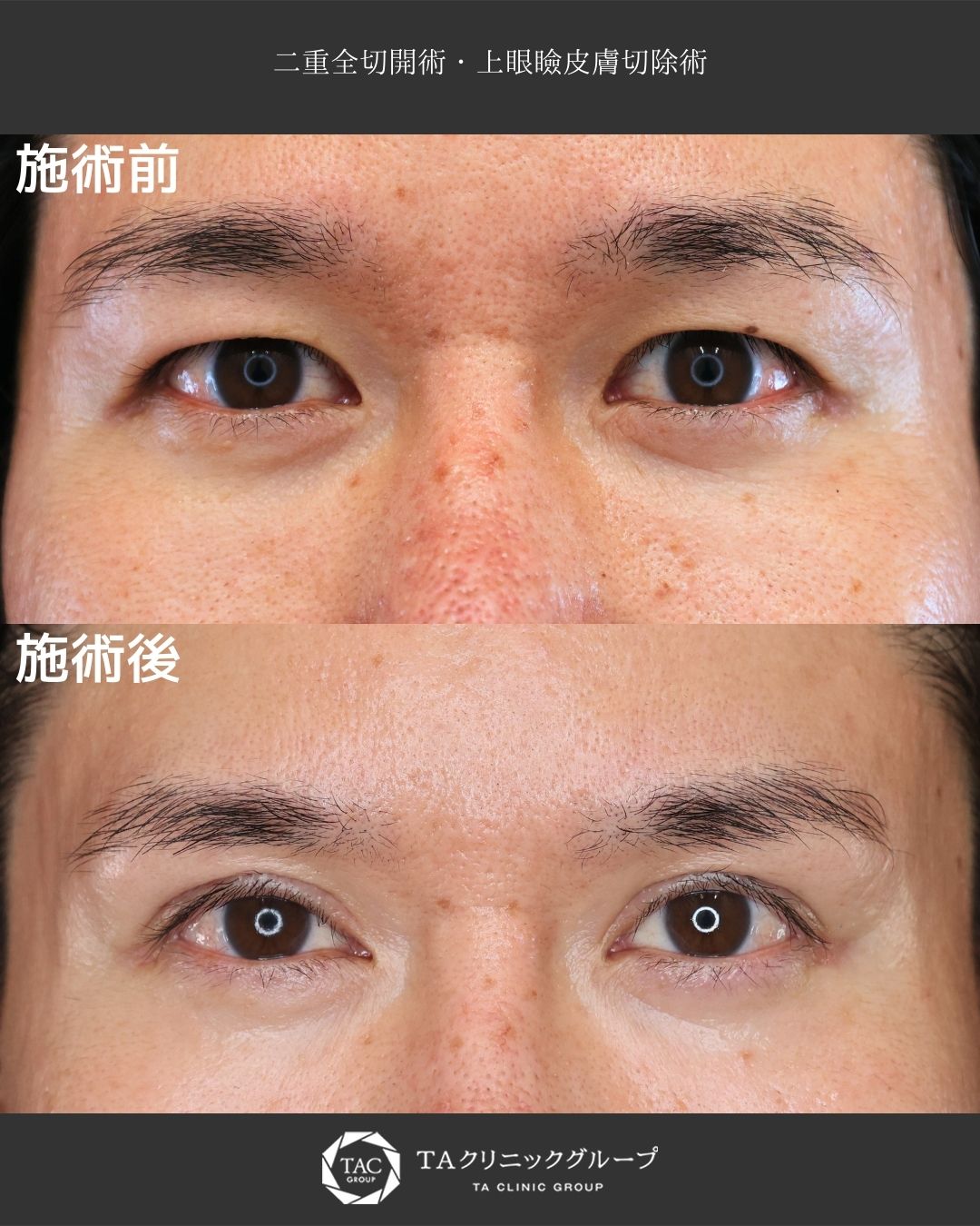 目元の重たさを解消し、自然な二重へ