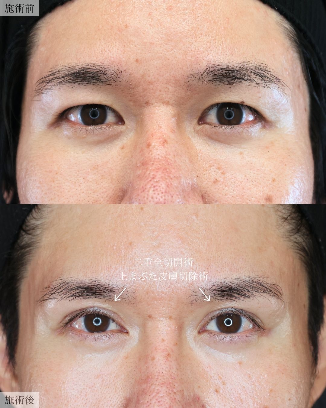二重切開（全切開法）/上眼瞼切開術の症例写真 施術前後 