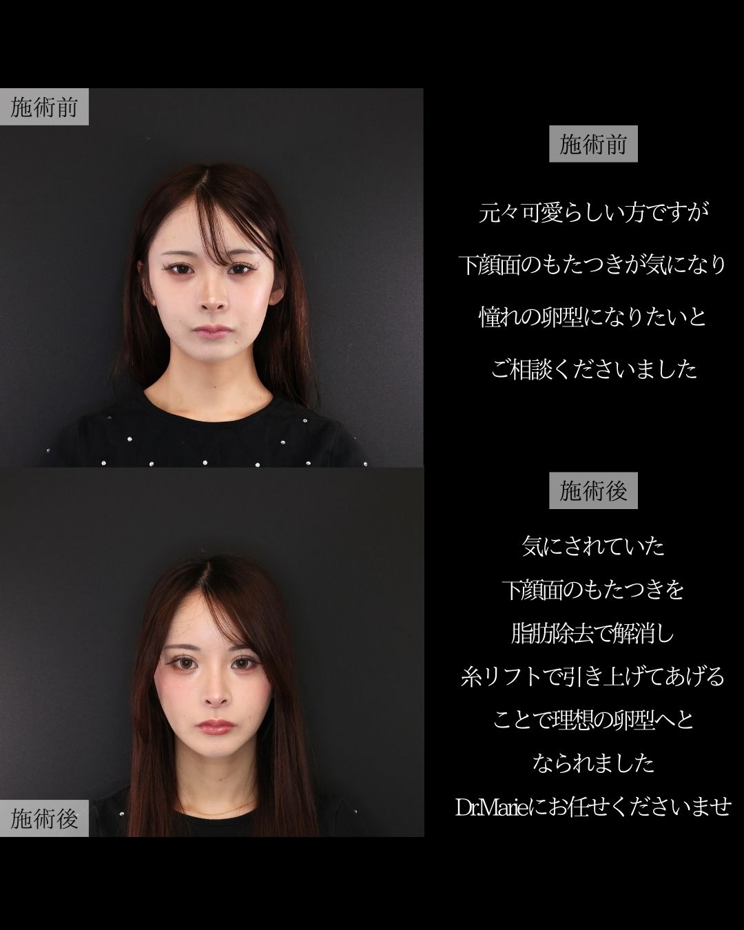 TAC式 ツヤ肌コラーゲンリフト®/ジョールファット除去/バッカルファット除去の症例写真 施術前後 