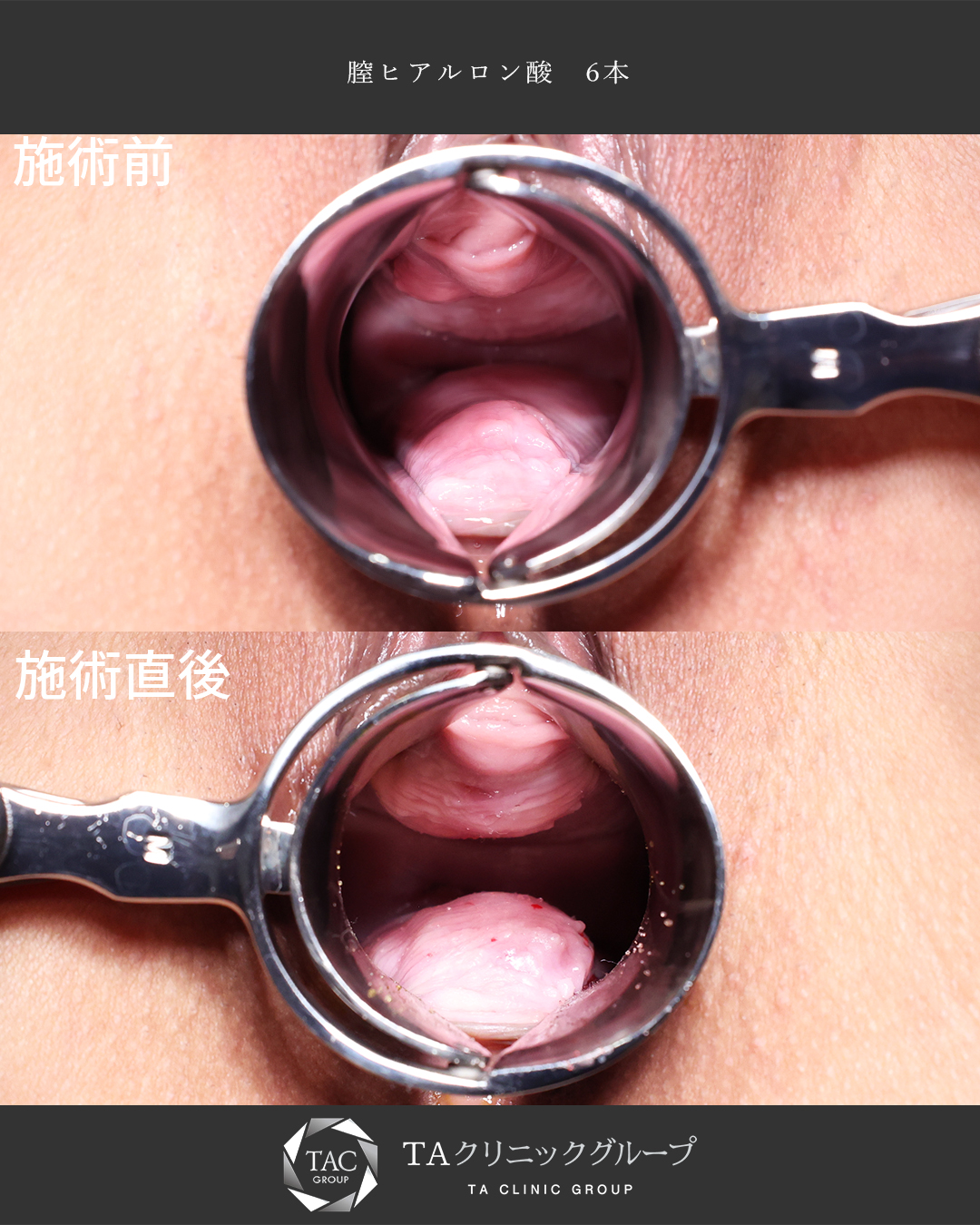 【膣ヒアルロン酸】膣トレで効果が感じられなかった方にもオススメ!