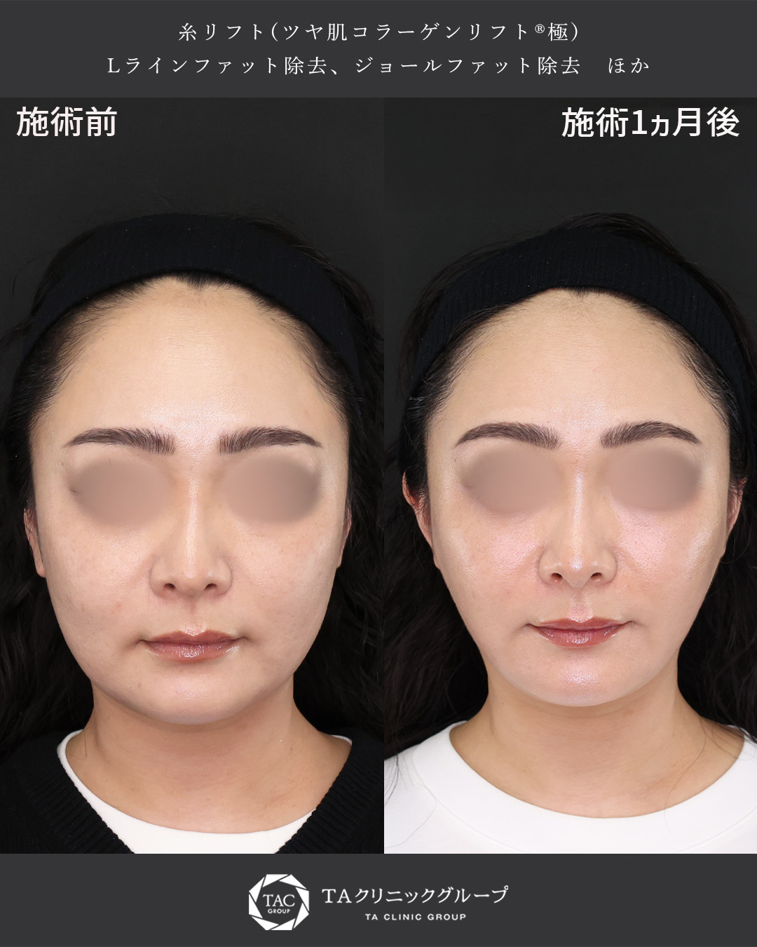 30代女性｜フェイスラインのたるみを糸リフト＋脂肪除去で改善【小顔＆美肌効果も】