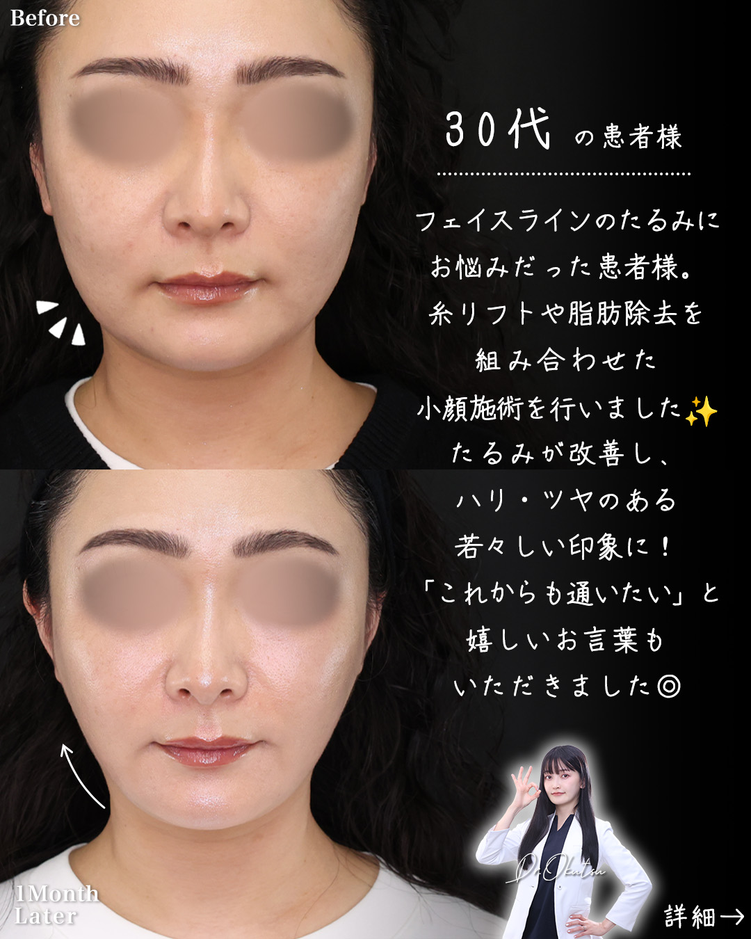 TAC式 ツヤ肌コラーゲンリフト®/Lラインファット除去（エラ下脂肪除去）/ジョールファット除去の症例写真 施術前後 