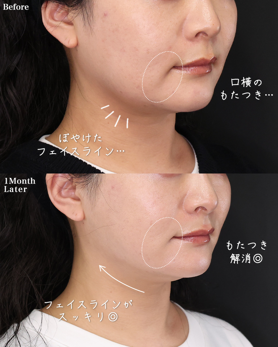 TAC式 ツヤ肌コラーゲンリフト®/Lラインファット除去（エラ下脂肪除去）/ジョールファット除去の症例写真 施術前後 