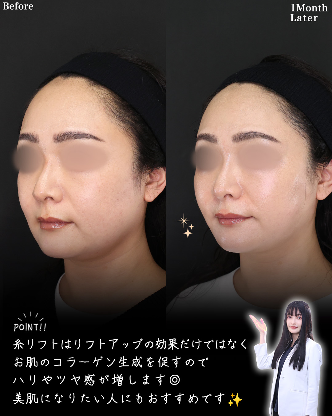 TAC式 ツヤ肌コラーゲンリフト®/Lラインファット除去（エラ下脂肪除去）/ジョールファット除去の症例写真 施術前後 