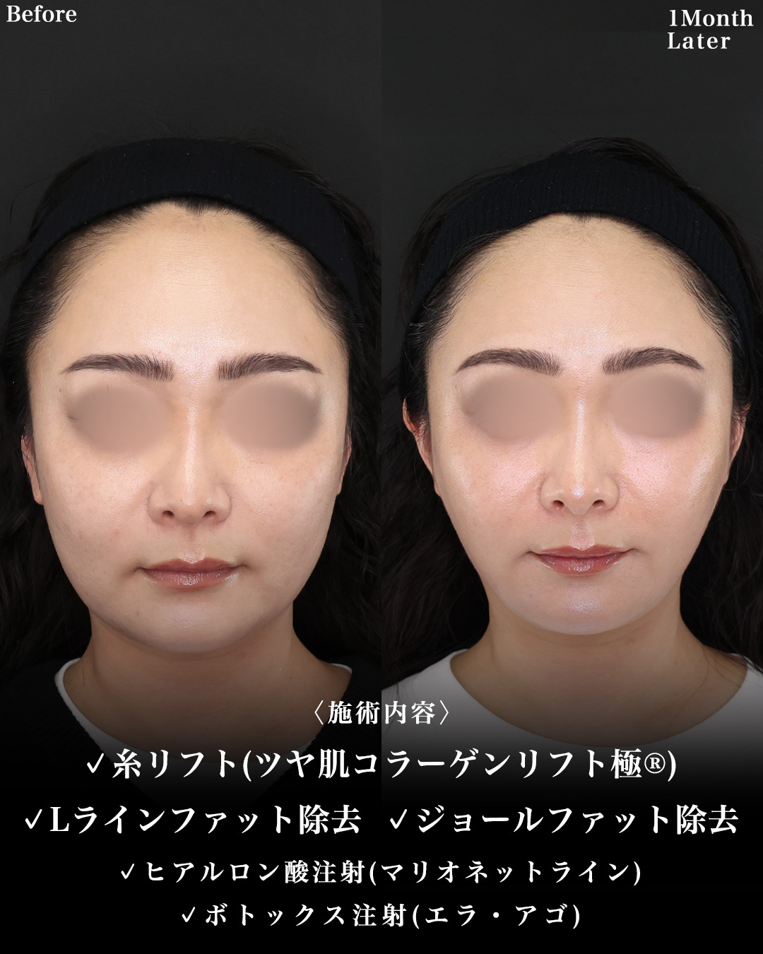 TAC式 ツヤ肌コラーゲンリフト®/Lラインファット除去（エラ下脂肪除去）/ジョールファット除去の症例写真 施術前後 