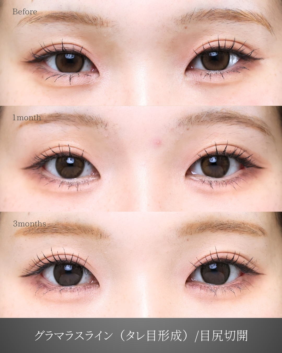 グラマラスライン（タレ目形成）/目尻切開術の症例写真 施術前後 