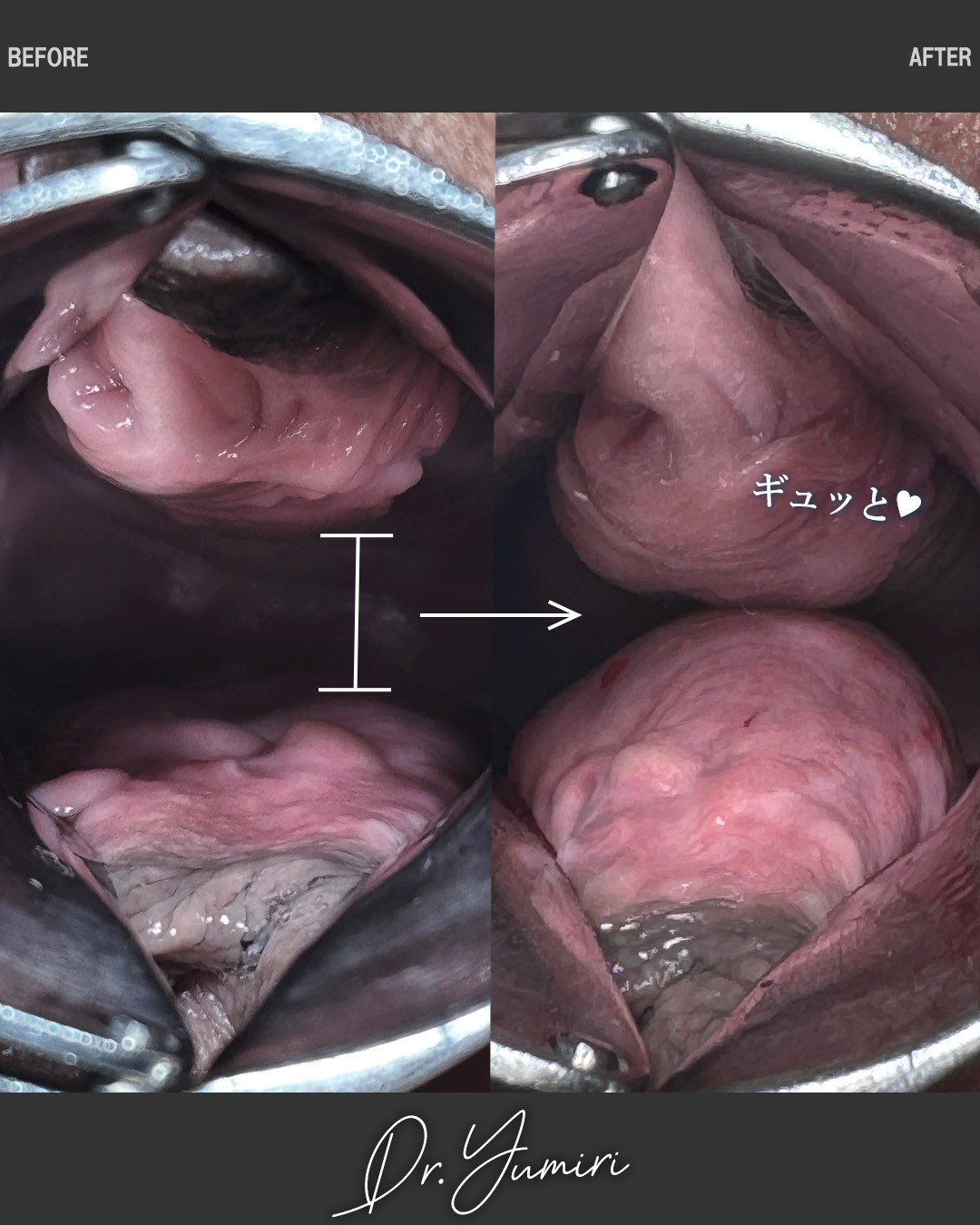 膣縮小術/Gショット不感症改善･膣感度アップ術/膣ハイフ（ヴィーナスハイフ）で膣圧向上の症例写真 施術前後 