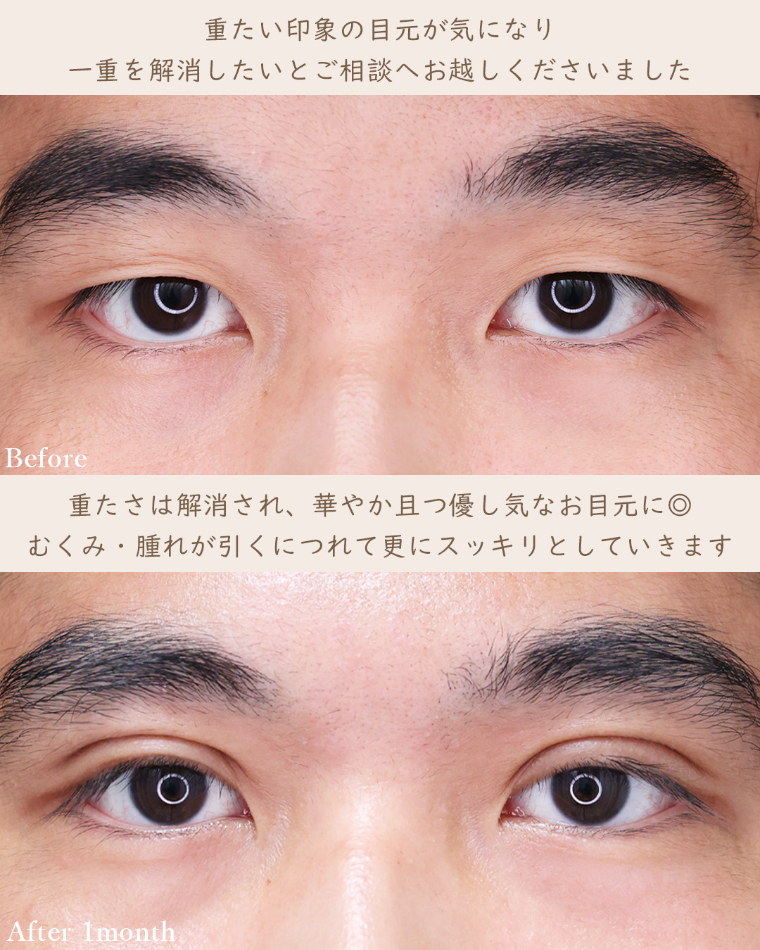 二重切開（全切開法）の症例写真 施術前後 