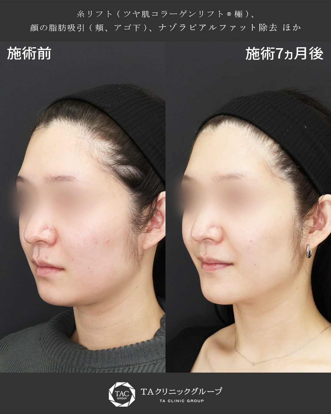 【7ヵ月後も美しい】自然で美しい輪郭へ