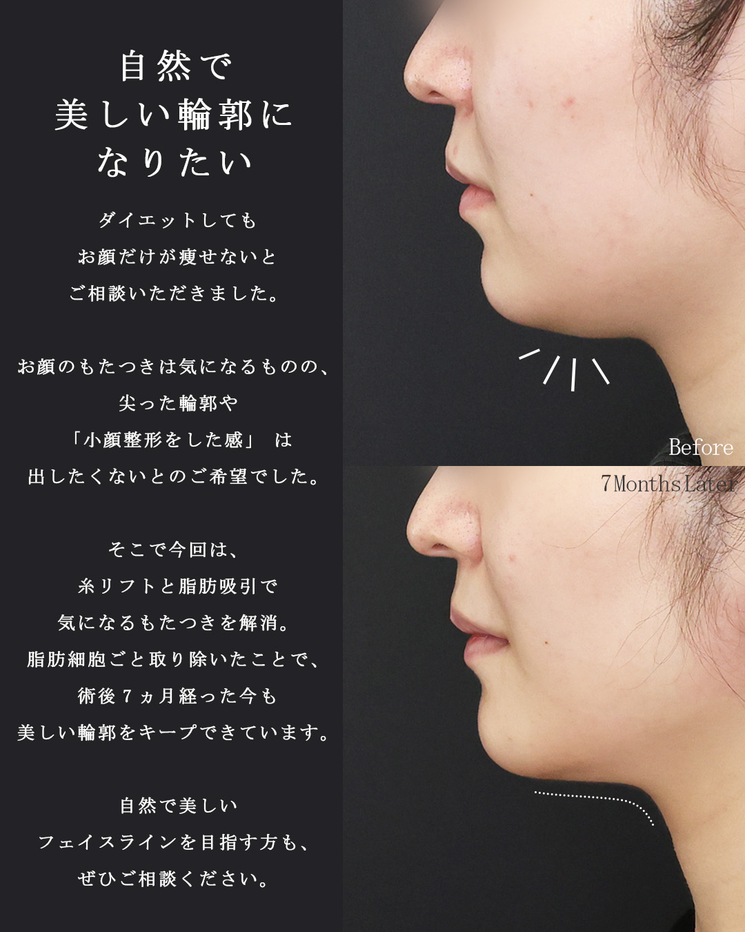 TAC式 ツヤ肌コラーゲンリフト®/ナゾラビアルファット除去/顎下の脂肪吸引の症例写真 施術前後 