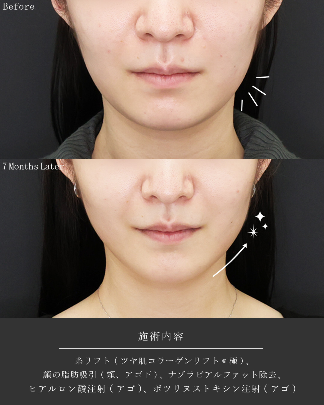 TAC式 ツヤ肌コラーゲンリフト®/ナゾラビアルファット除去/顎下の脂肪吸引の症例写真 施術前後 