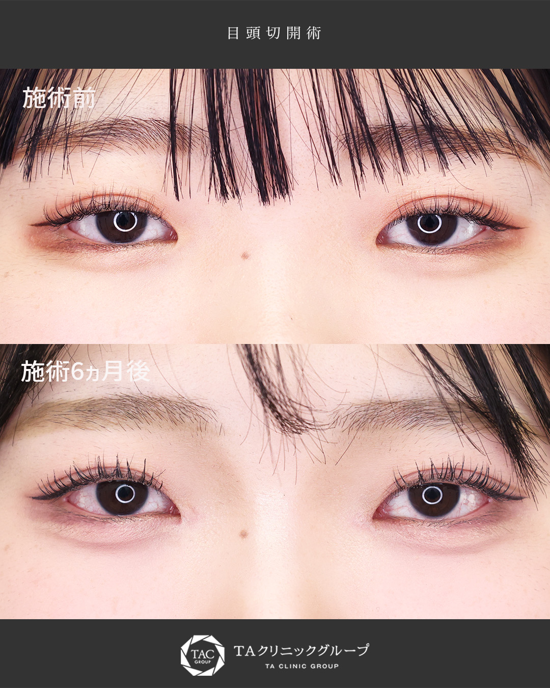 【目頭切開】一気に大人っぽい目元に