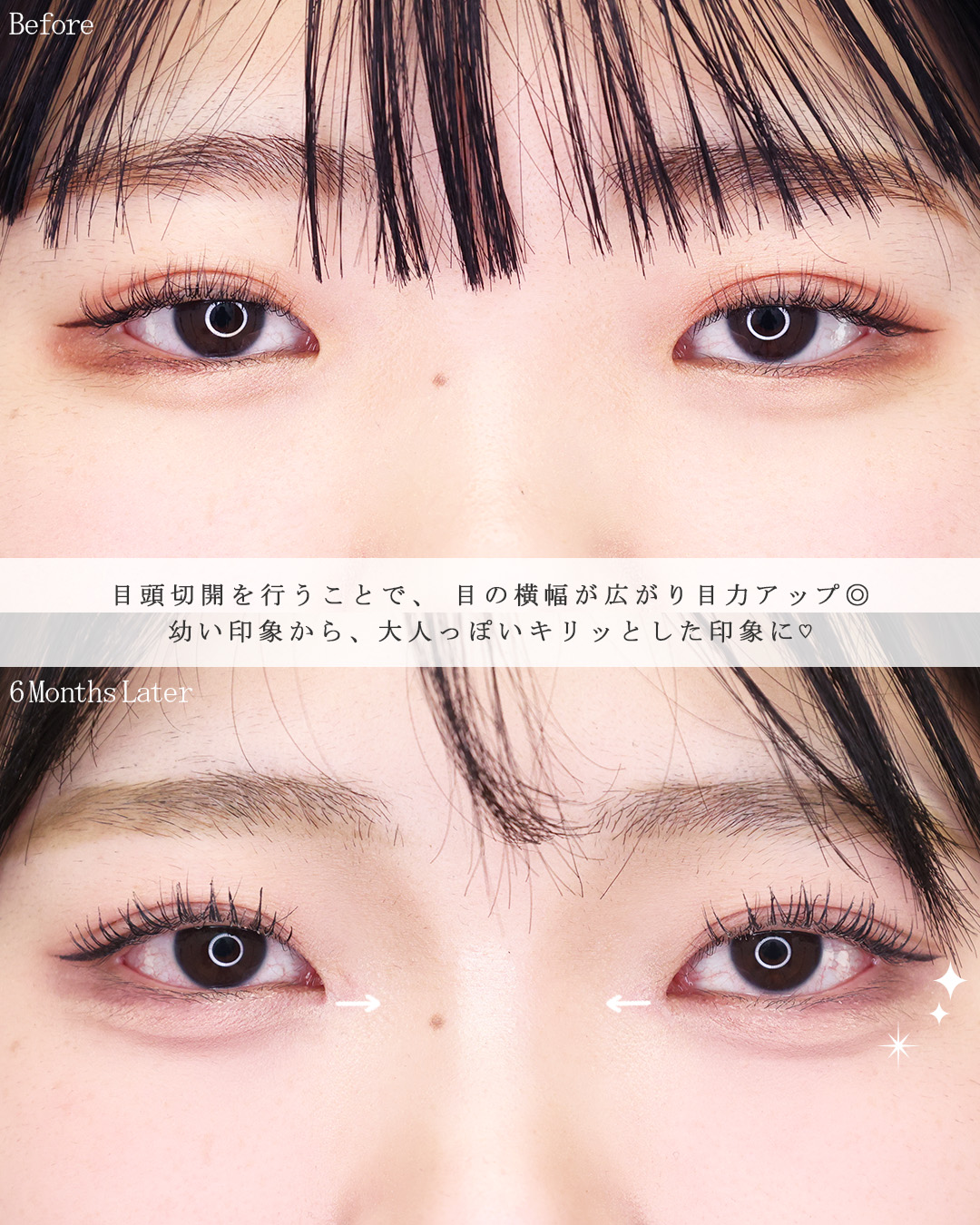 目頭切開術の症例写真 施術前後 