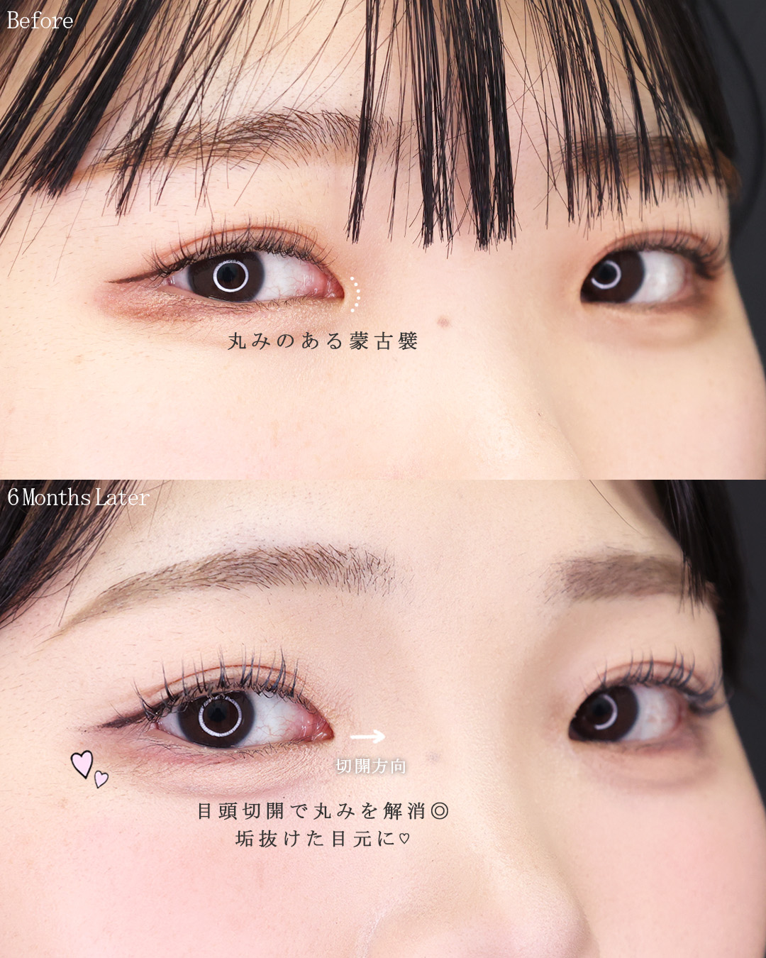 目頭切開術の症例写真 施術前後 