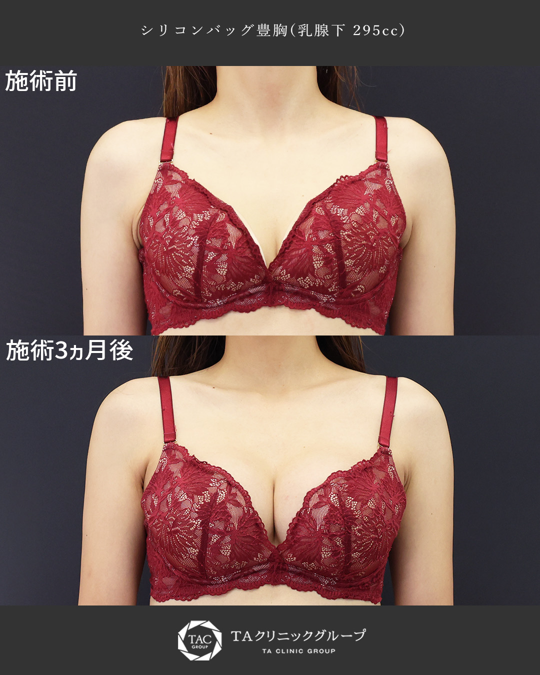 【女医が執刀で安心】憧れの美バスト誕生