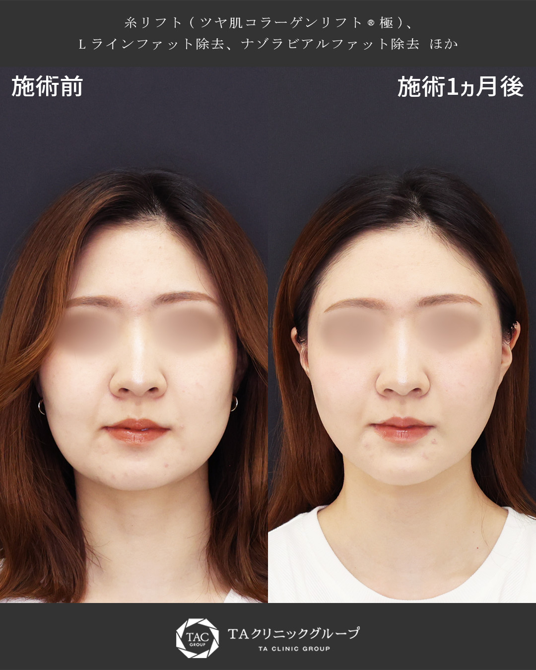 【20代の別人級小顔整形】気になる輪郭の形とボリューム改善！