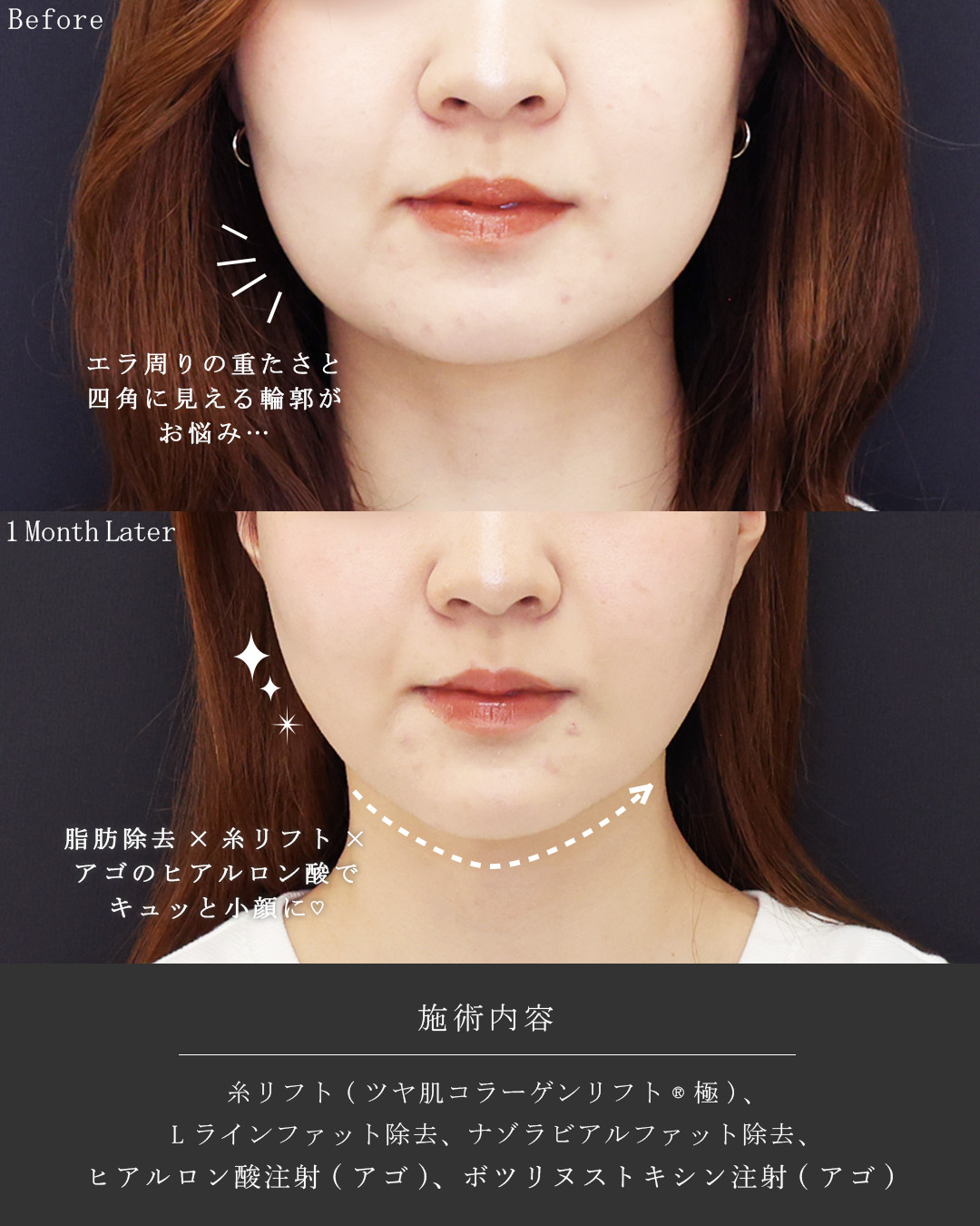 TAC式 ツヤ肌コラーゲンリフト®/Lラインファット除去（エラ下脂肪除去）/ナゾラビアルファット除去の症例写真 施術前後 