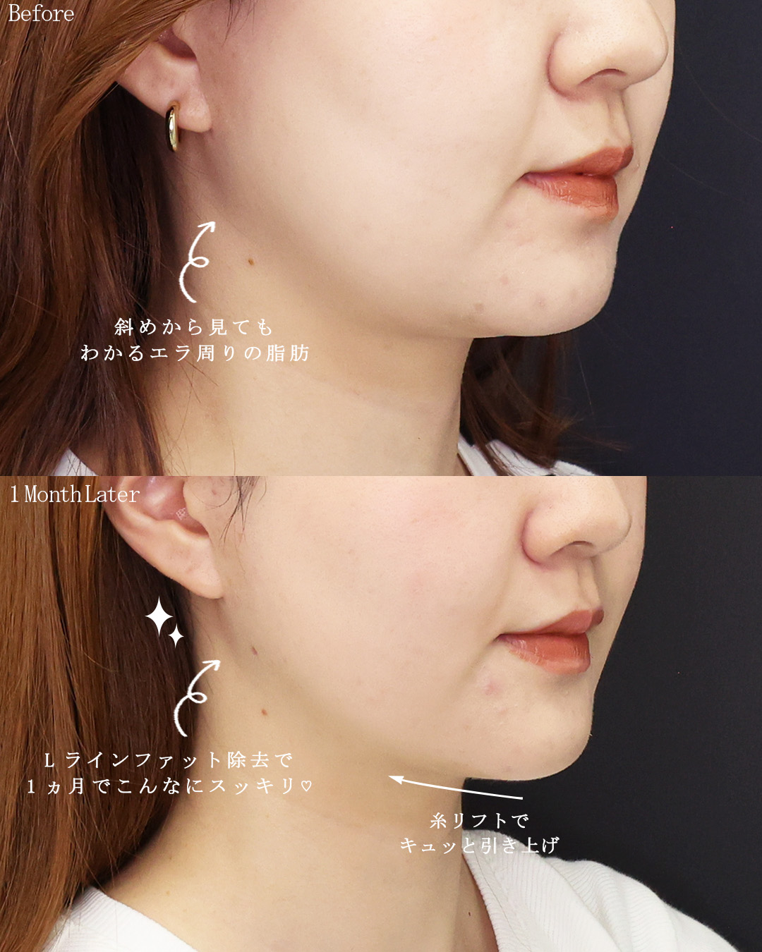 TAC式 ツヤ肌コラーゲンリフト®/Lラインファット除去（エラ下脂肪除去）/ナゾラビアルファット除去の症例写真 施術前後 
