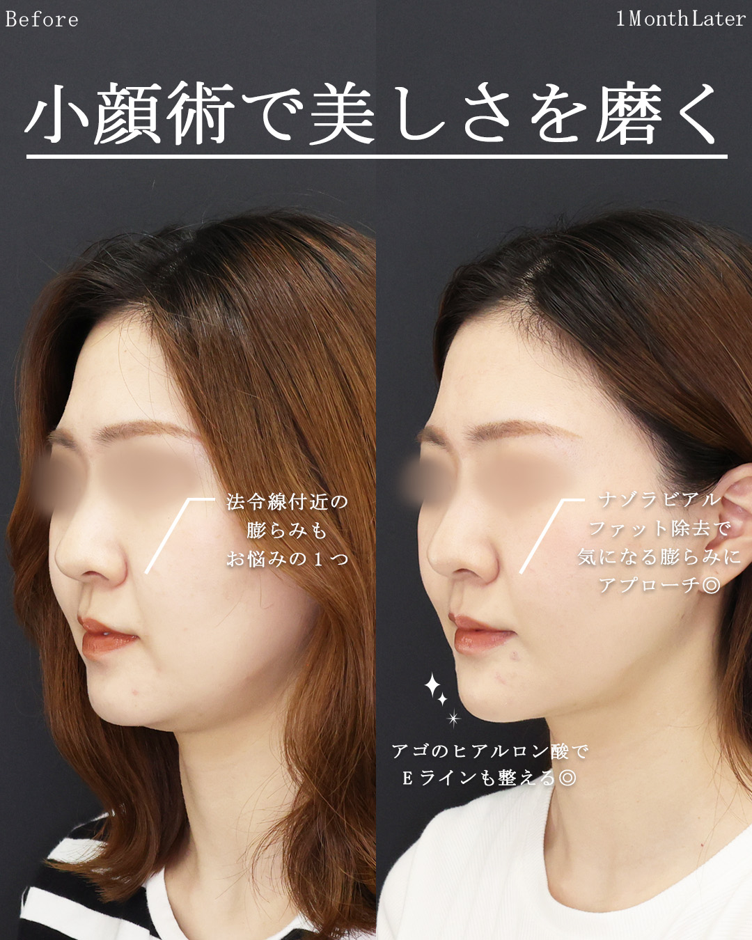 TAC式 ツヤ肌コラーゲンリフト®/Lラインファット除去（エラ下脂肪除去）/ナゾラビアルファット除去の症例写真 施術前後 