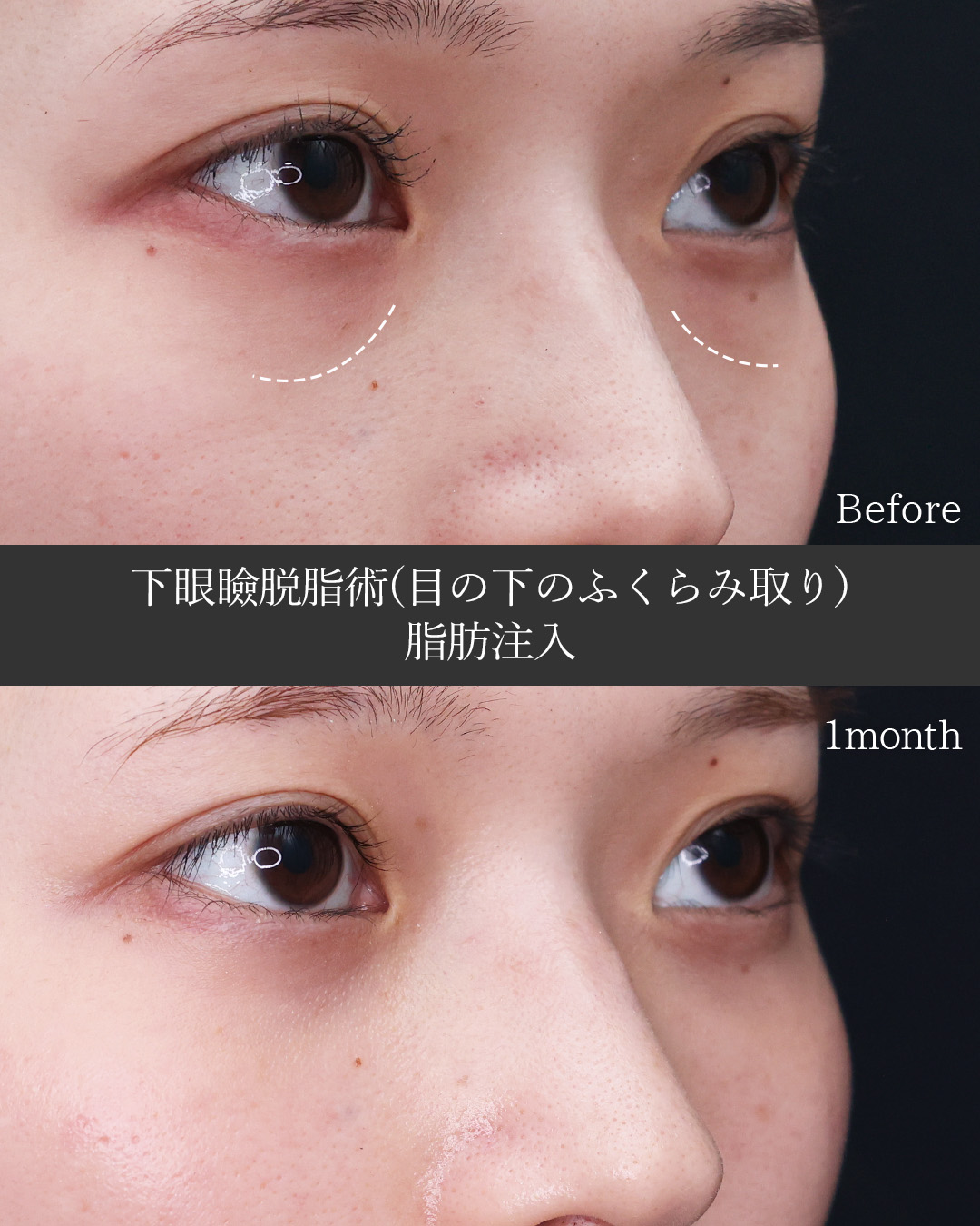 下眼瞼脱脂術（目の下のたるみ取り・目の下の脂肪ふくらみ取り）/顔の脂肪注入(コンデンスリッチフェイス)の症例写真 施術前後 