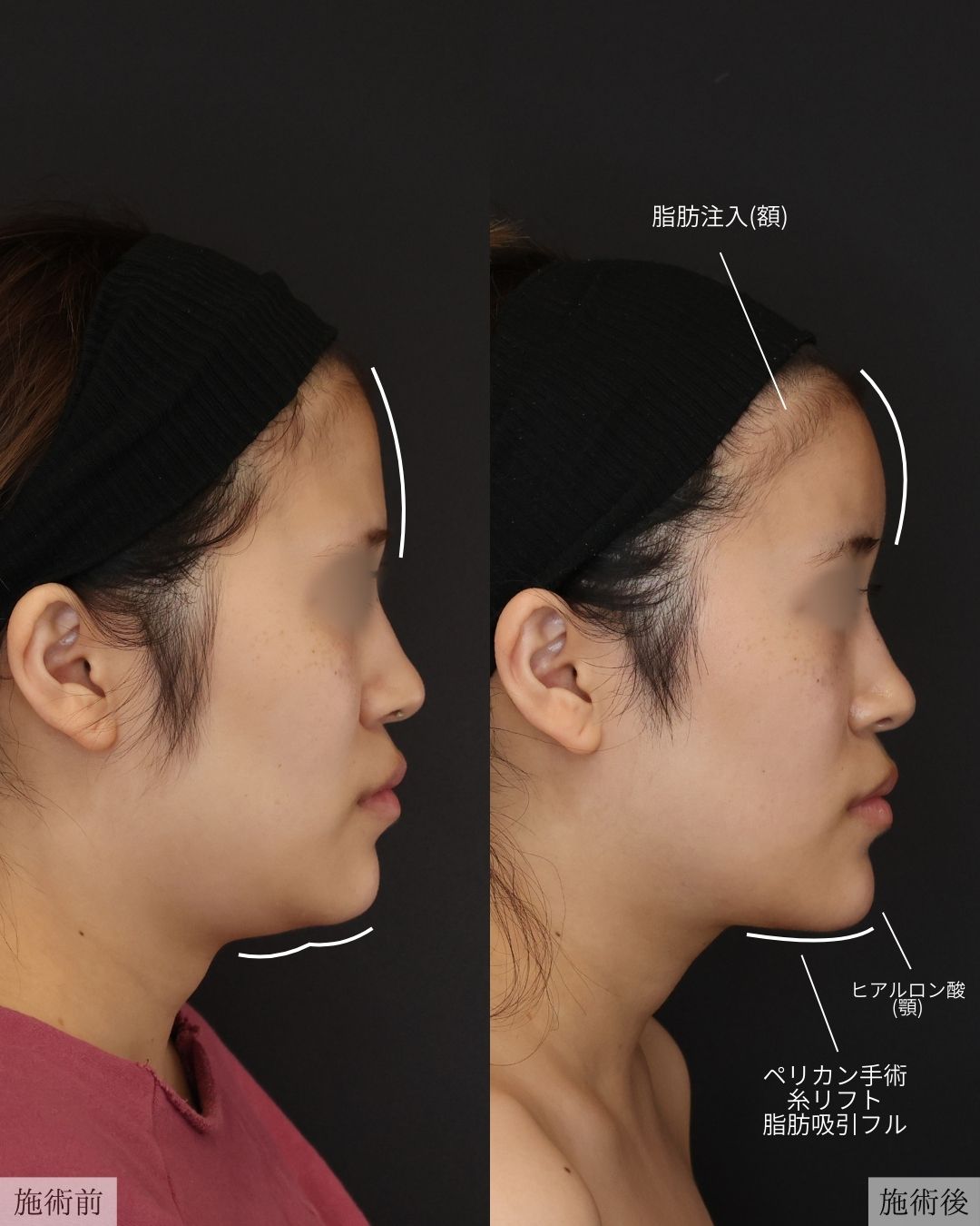 バッカルファット除去/エラボトックス注射/ジョールファット除去の症例写真 施術前後 