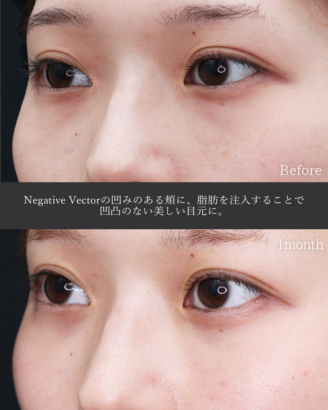 下眼瞼脱脂術（目の下のたるみ取り・目の下の脂肪ふくらみ取り）/顔の脂肪注入(コンデンスリッチフェイス)の症例写真 施術前後 