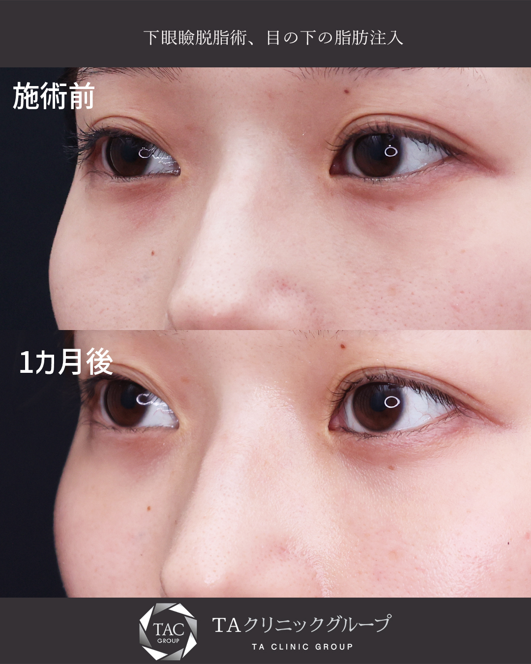 【クマ取り×脂肪注入】凹凸のない美しい目元に