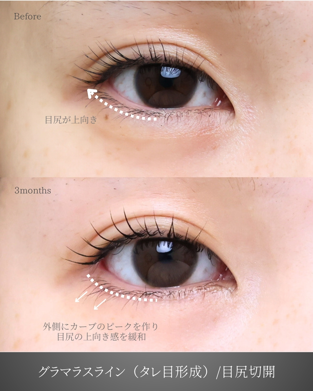 グラマラスライン（タレ目形成）/目尻切開術の症例写真 施術前後 