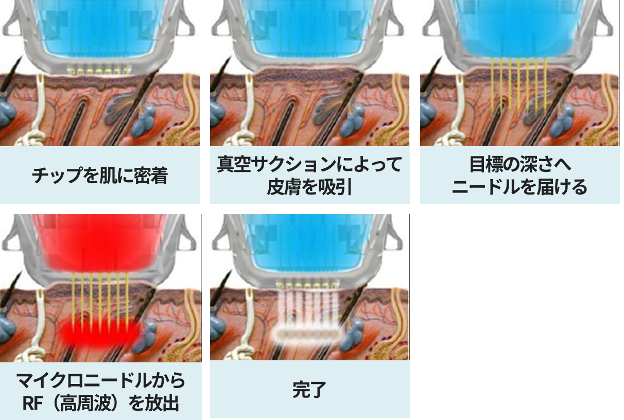 真空サクション機能のフロー図