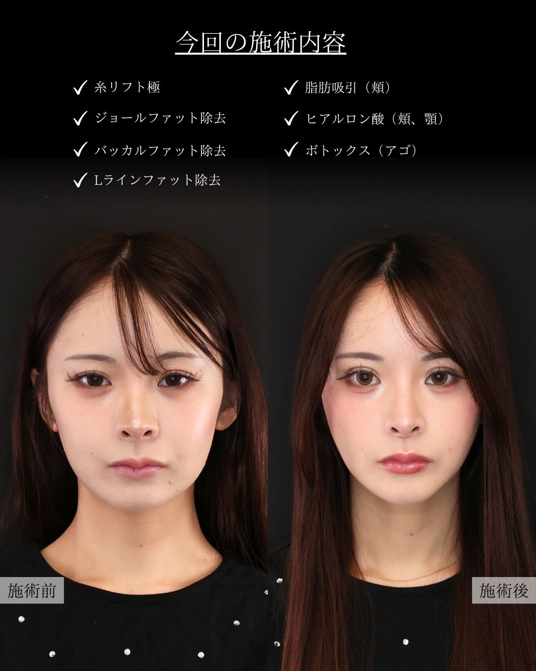 TAC式 ツヤ肌コラーゲンリフト®/ジョールファット除去/バッカルファット除去の症例写真 施術前後 