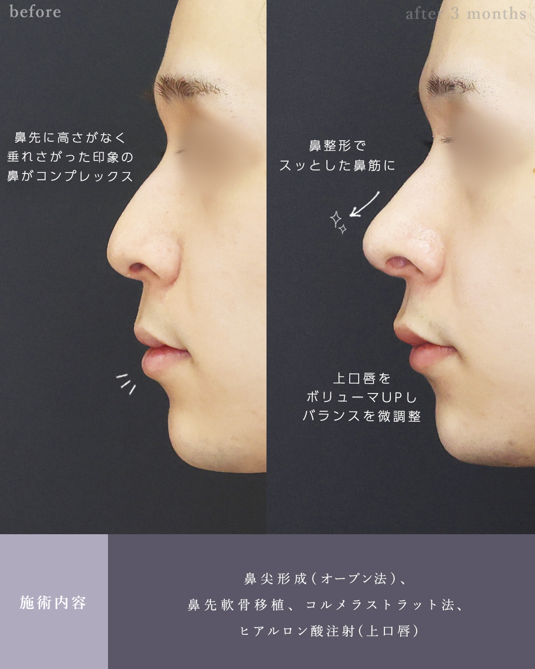 鼻尖形成・鼻尖縮小/鼻先軟骨移植/ヒアルロン酸注射：その他の症例写真 施術前後 