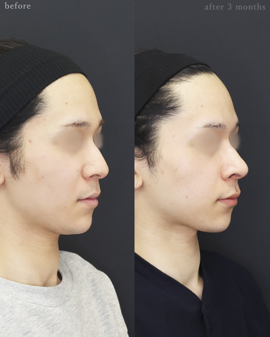 鼻尖形成・鼻尖縮小/鼻先軟骨移植/ヒアルロン酸注射：その他の症例写真 施術前後 