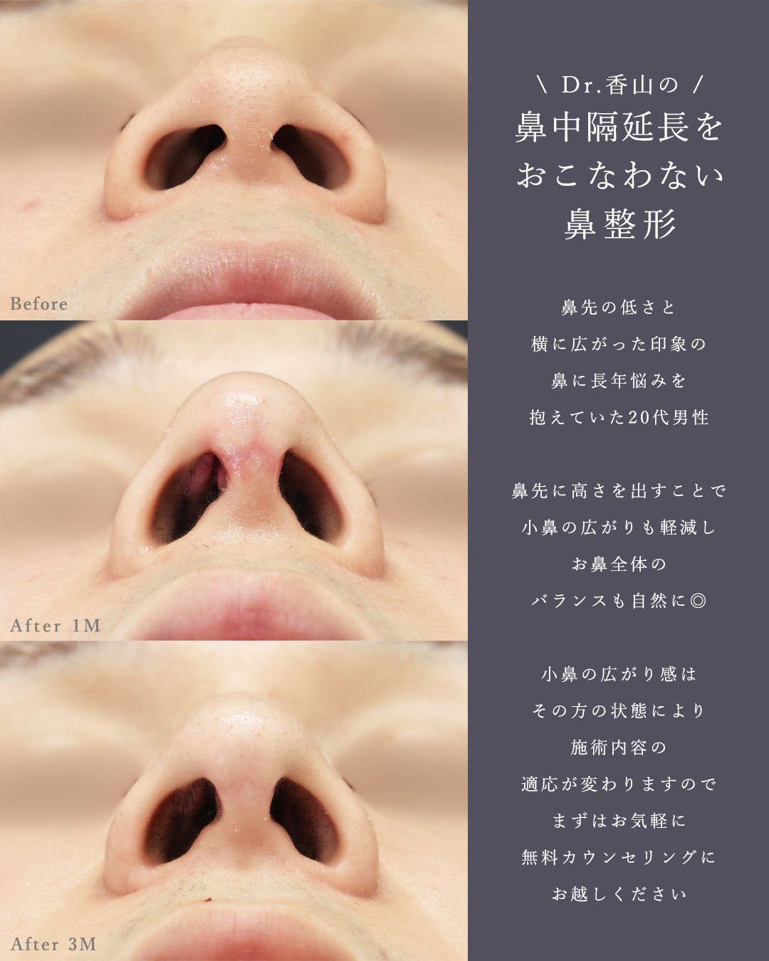 鼻尖形成・鼻尖縮小/鼻先軟骨移植/ヒアルロン酸注射：その他の症例写真 施術前後 