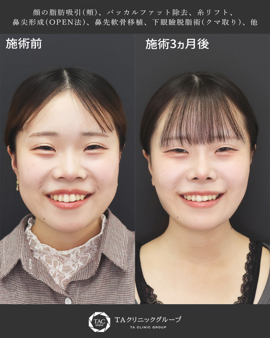 【10代の別人級の垢抜け】形成外科専門医執刀|糸リフト×脂肪吸引×鼻整形×クマ取り