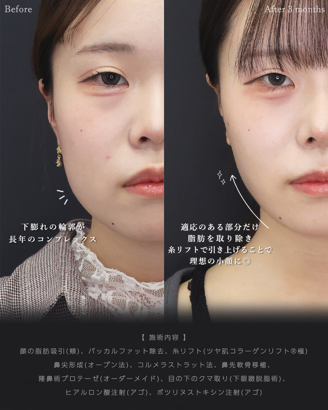 バッカルファット除去/顔の脂肪吸引/TAC式 ツヤ肌コラーゲンリフト®の症例写真 施術前後 