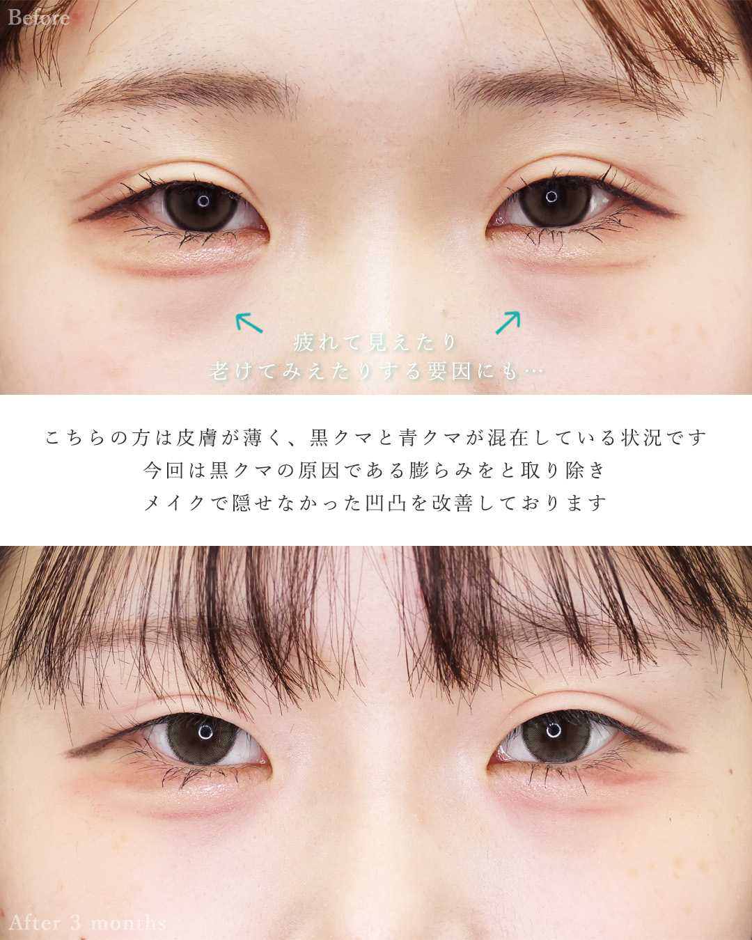 バッカルファット除去/顔の脂肪吸引/TAC式 ツヤ肌コラーゲンリフト®の症例写真 施術前後 