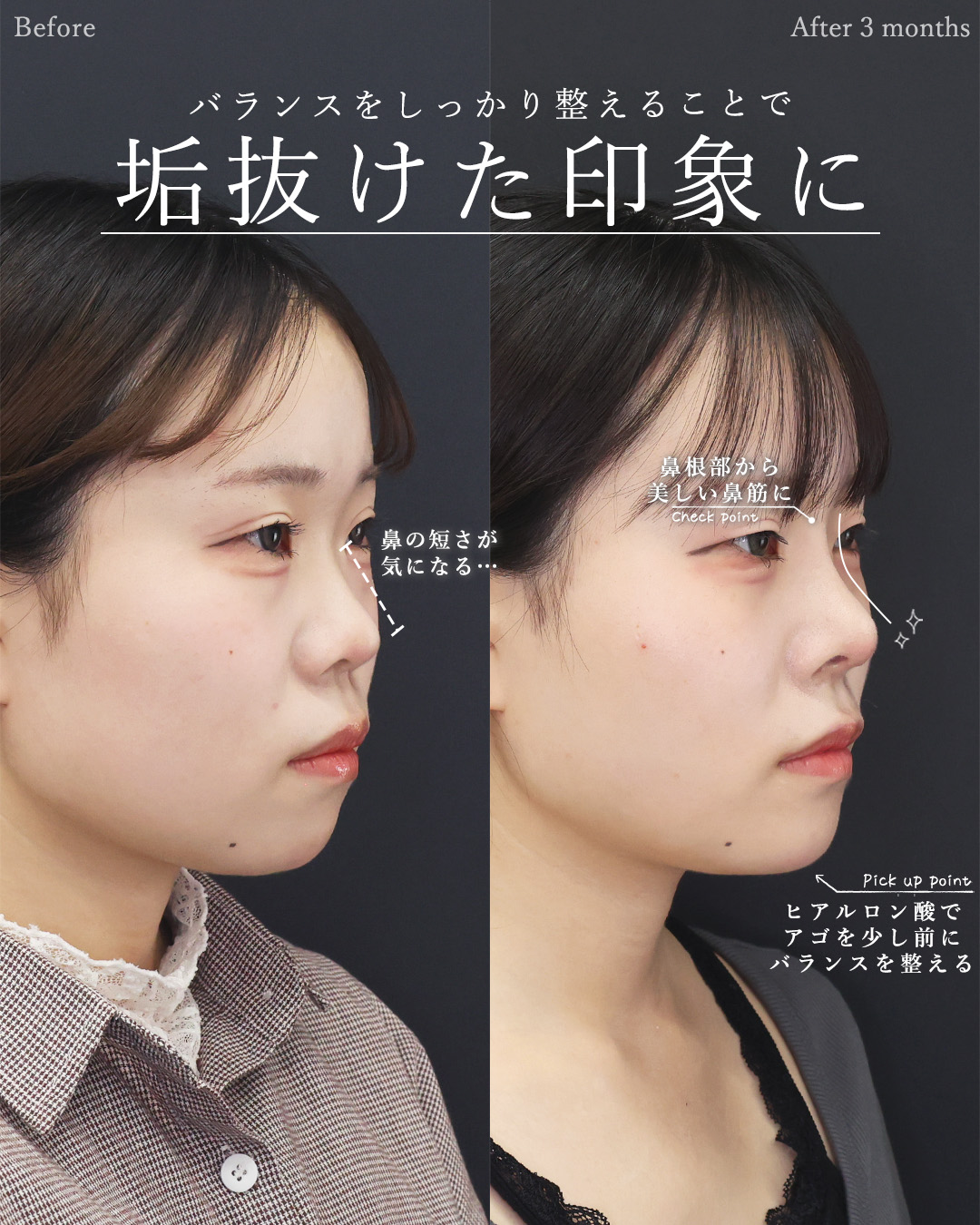 バッカルファット除去/顔の脂肪吸引/TAC式 ツヤ肌コラーゲンリフト®の症例写真 施術前後 